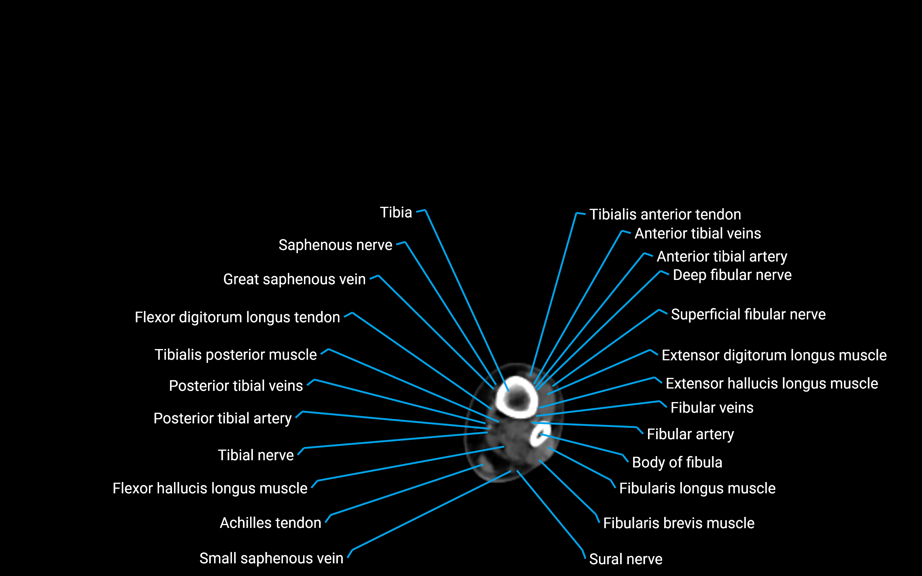 CT Lower leg axial cross sectional anatomy labelled image 156 (2).png